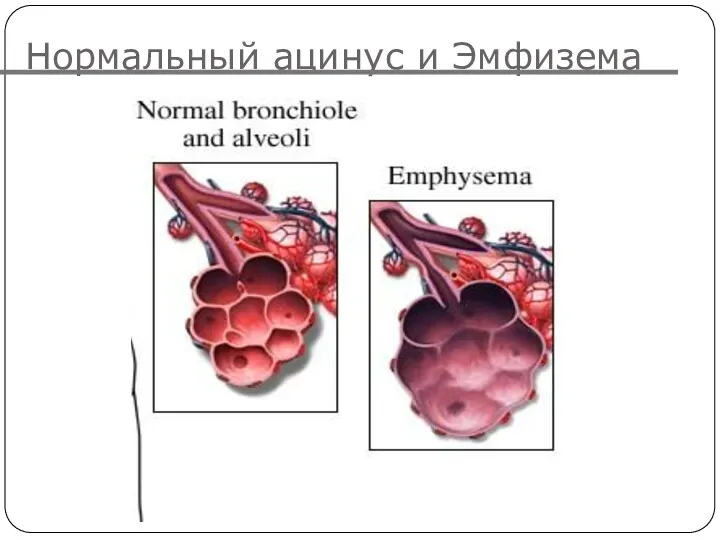 Нормальный ацинус и Эмфизема