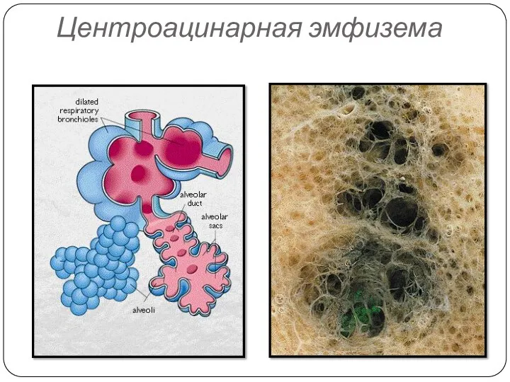 Центроацинарная эмфизема