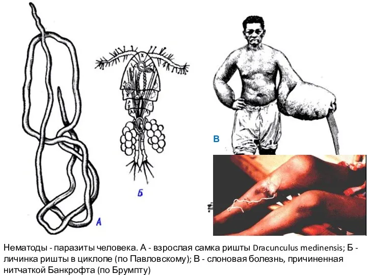 Нематоды - паразиты человека. А - взрослая самка ришты Dracunculus