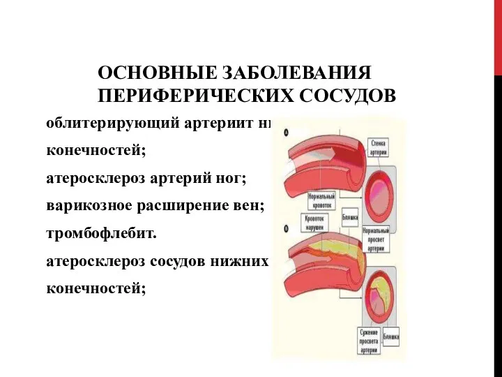 ОСНОВНЫЕ ЗАБОЛЕВАНИЯ ПЕРИФЕРИЧЕСКИХ СОСУДОВ облитерирующий артериит нижних конечностей; атеросклероз артерий