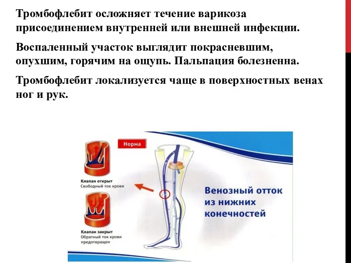 Тромбофлебит осложняет течение варикоза присоединением внутренней или внешней инфекции. Воспаленный