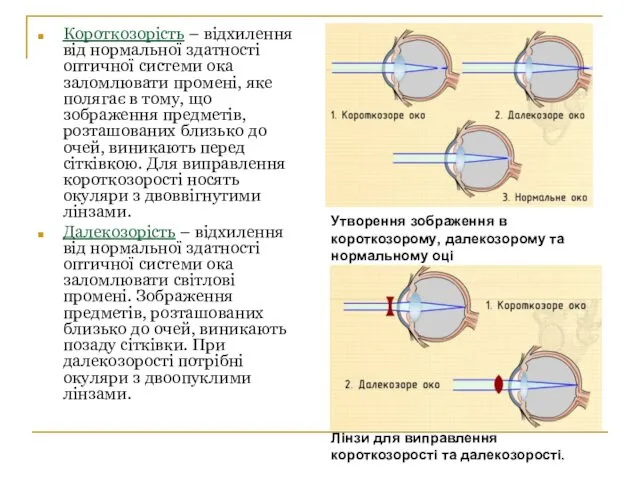 Короткозорість – відхилення від нормальної здатності оптичної системи ока заломлювати