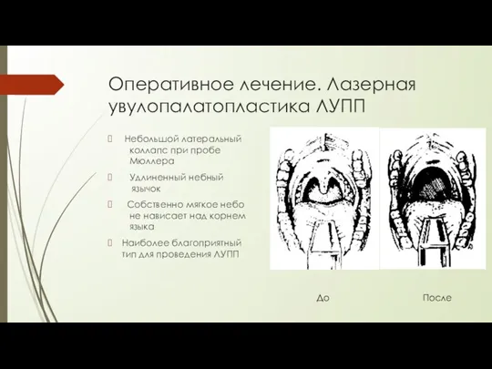 Оперативное лечение. Лазерная увулопалатопластика ЛУПП Небольшой латеральный коллапс при пробе