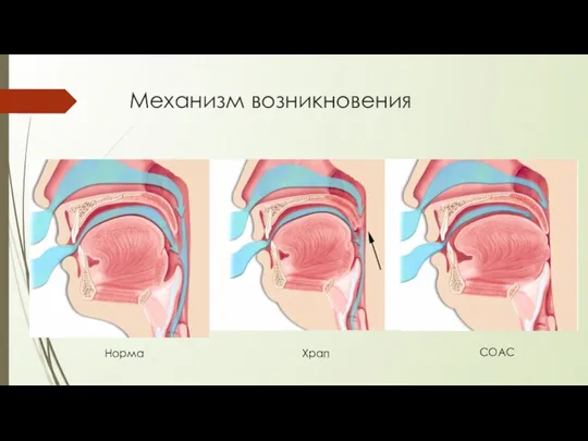 Механизм возникновения Норма Храп СОАС