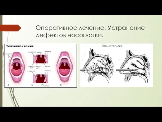 Оперативное лечение. Устранение дефектов носоглотки. Полипотомия