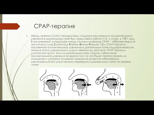 СРАР-терапия Метод лечения СОАС посредством создания постоянного положительного давления в