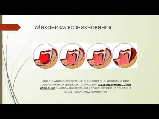 Механизм возникновения При синдроме обструктивного апноэ сна, особенно при средне-тяжелых