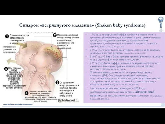 Синдром «встряхнутого младенца» (Shaken baby syndrome) 1946 году доктор Джон