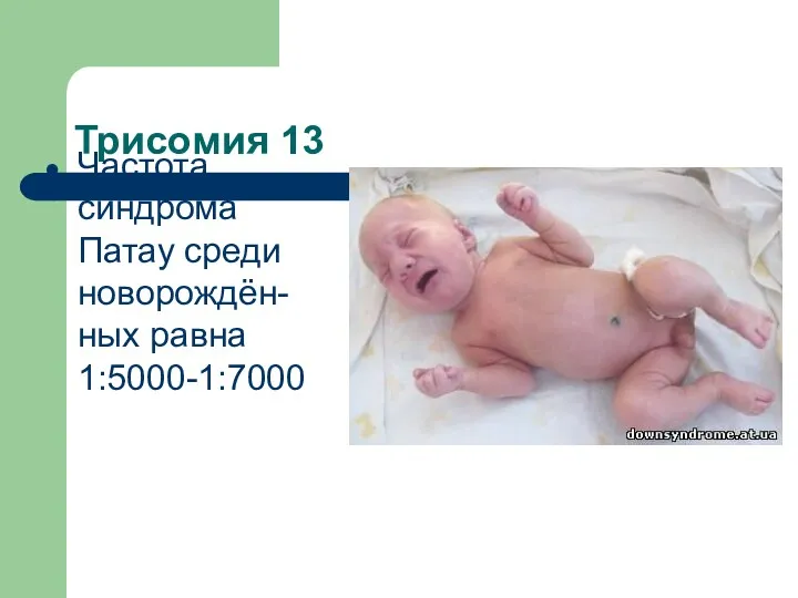 Трисомия 13 Частота синдрома Патау среди новорождён-ных равна 1:5000-1:7000