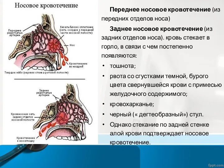 Переднее носовое кровотечение (из передних отделов носа) Заднее носовое кровотечение