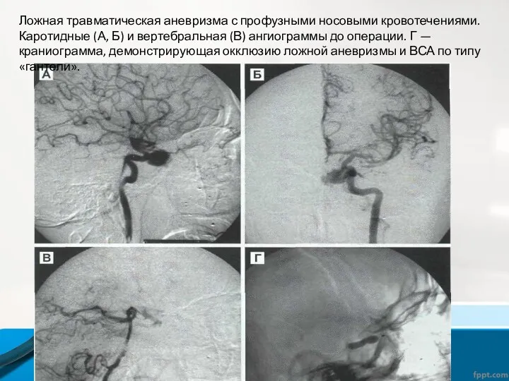 Ложная травматическая аневризма с профузными носовыми кровотечениями. Каротидные (А, Б)