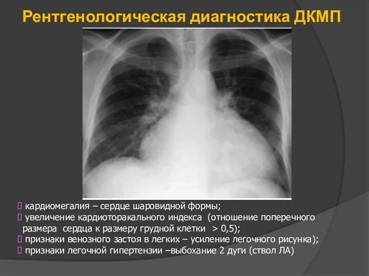 Рентгенологическая диагностика ДКМП кардиомегалия – сердце шаровидной формы; увеличение кардиоторакального