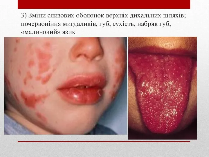 3) Зміни слизових оболонок верхніх дихальних шляхів; почервоніння мигдаликів, губ, сухість, набряк губ, «малиновий» язик