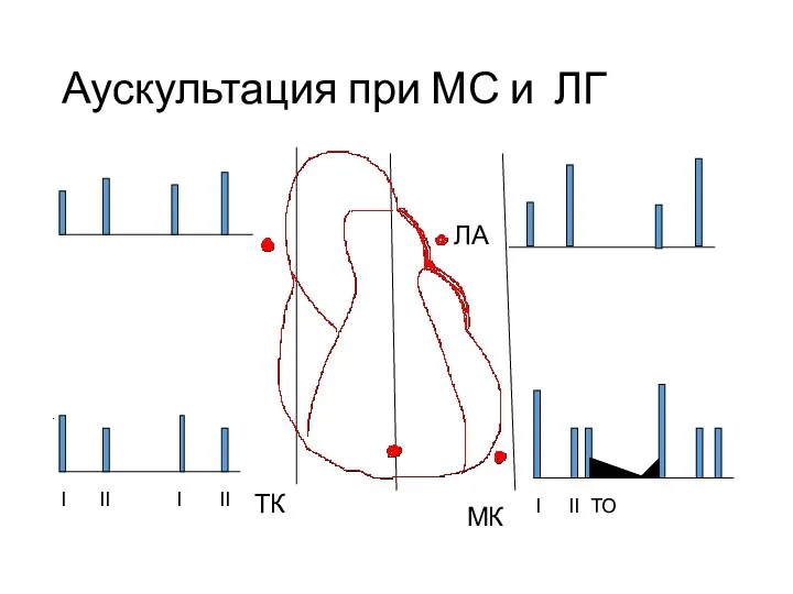 Аускультация при МС и ЛГ I II ТО I II I II ЛА МК ТК