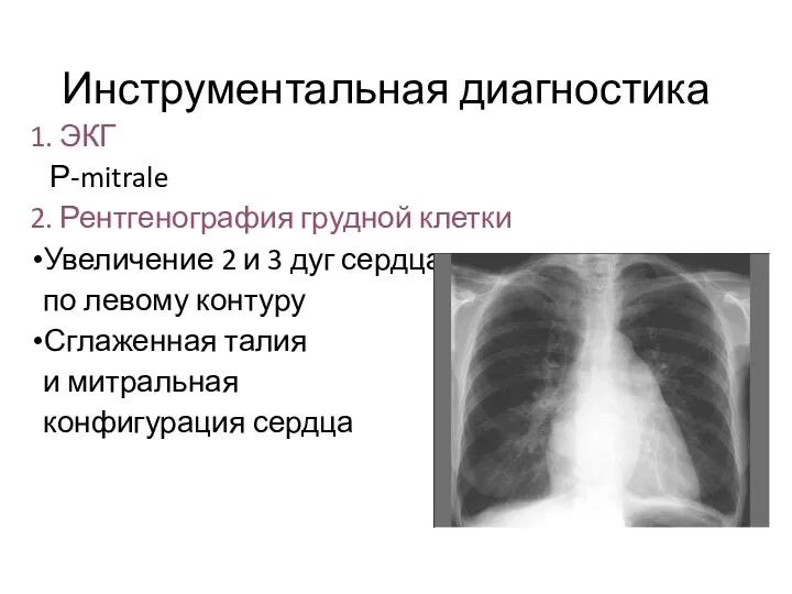 Инструментальная диагностика 1. ЭКГ Р-mitrale 2. Рентгенография грудной клетки Увеличение