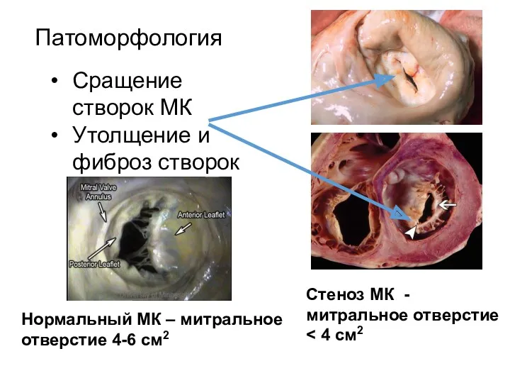 Патоморфология Сращение створок МК Утолщение и фиброз створок Нормальный МК