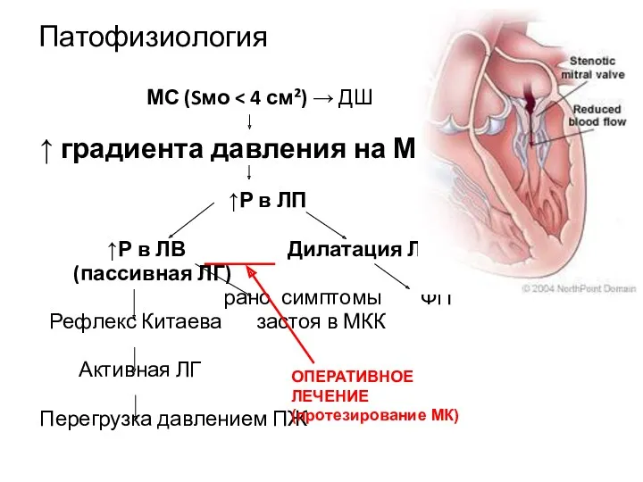 Патофизиология МС (Sмо ↑ градиента давления на МК ↑Р в