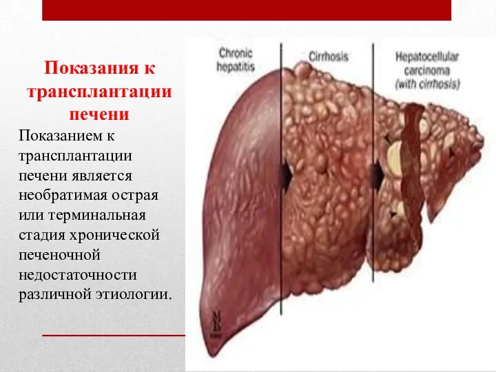 Показания к трансплантации печени Показанием к трансплантации печени является необратимая острая или терминальная