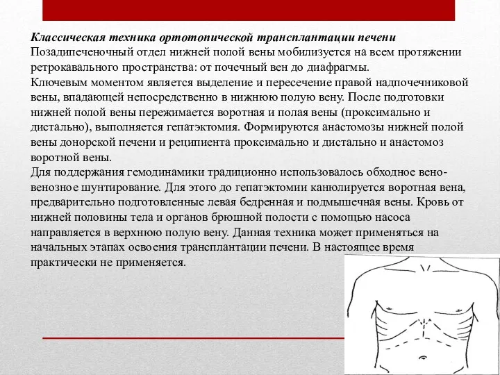 Классическая техника ортотопической трансплантации печени Позадипеченочный отдел нижней полой вены мобилизуется на всем