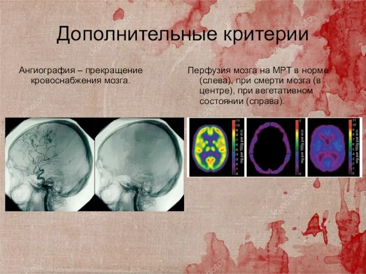 Ангиография – прекращение кровоснабжения мозга. Перфузия мозга на МРТ в норме (слева), при