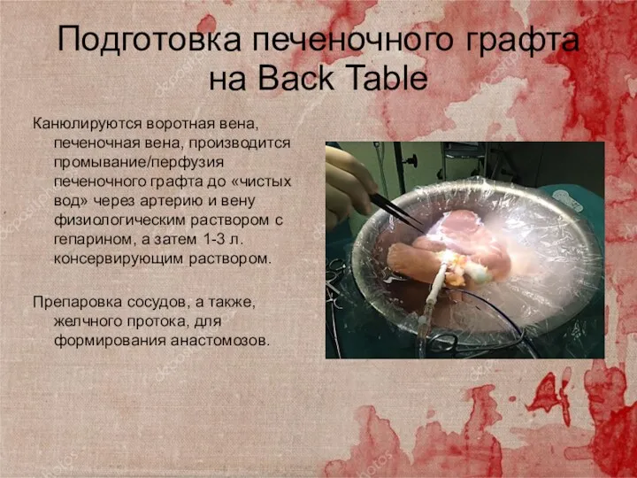 Подготовка печеночного графта на Baсk Table Канюлируются воротная вена, печеночная вена, производится промывание/перфузия
