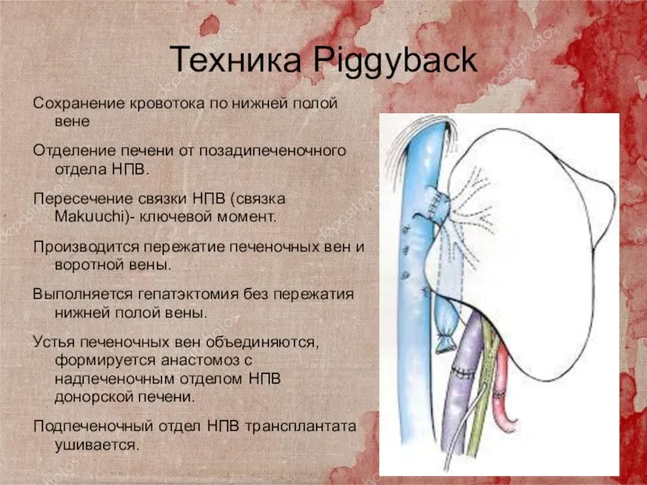 Техника Piggyback Сохранение кровотока по нижней полой вене Отделение печени от позадипеченочного отдела