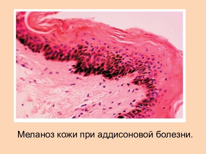 Меланоз кожи при аддисоновой болезни.