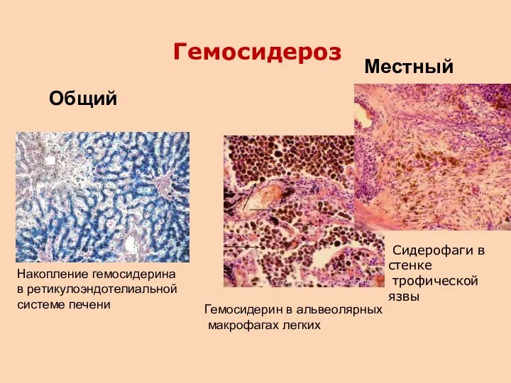 Сидерофаги в стенке трофической язвы Гемосидероз Общий Местный Гемосидерин в