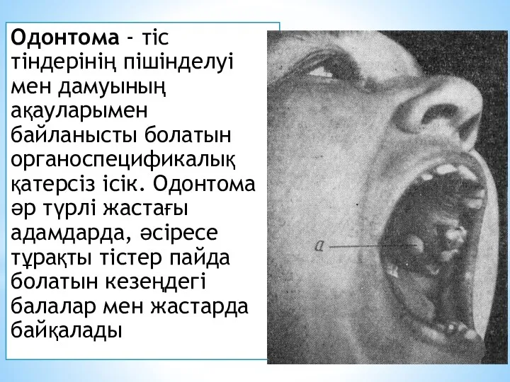 Одонтома - тіс тіндерінің пішінделуі мен дамуының ақауларымен байланысты болатын