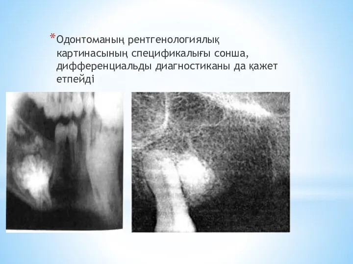 Одонтоманың рентгенологиялық картинасының спецификалығы сонша, дифференциальды диагностиканы да қажет етпейді