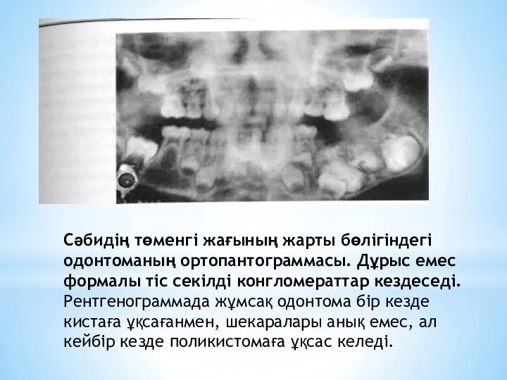 Сәбидің төменгі жағының жарты бөлігіндегі одонтоманың ортопантограммасы. Дұрыс емес формалы тіс секілді конгломераттар