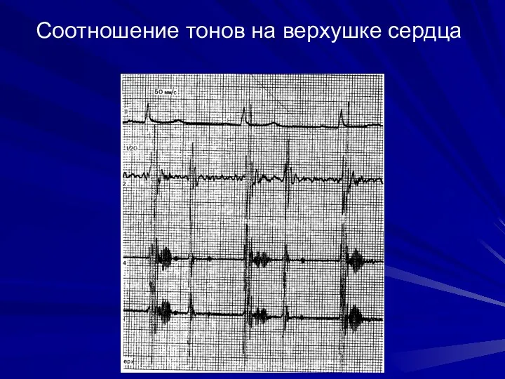 Соотношение тонов на верхушке сердца