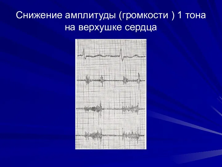 Снижение амплитуды (громкости ) 1 тона на верхушке сердца