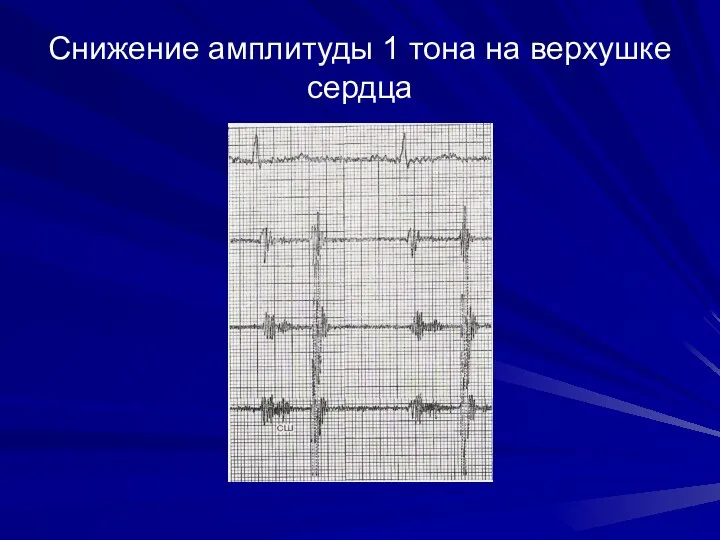 Снижение амплитуды 1 тона на верхушке сердца