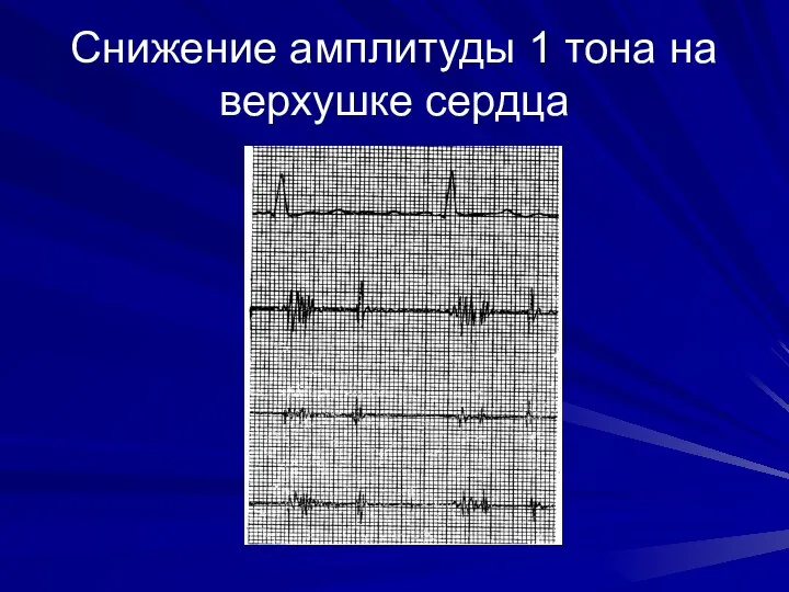 Снижение амплитуды 1 тона на верхушке сердца