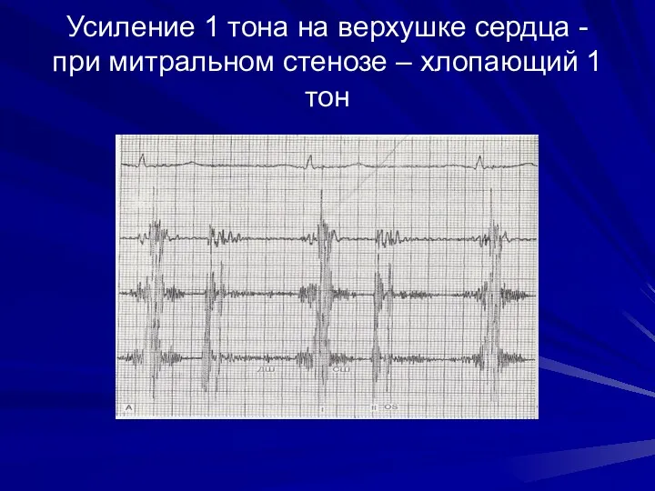 Усиление 1 тона на верхушке сердца - при митральном стенозе – хлопающий 1 тон