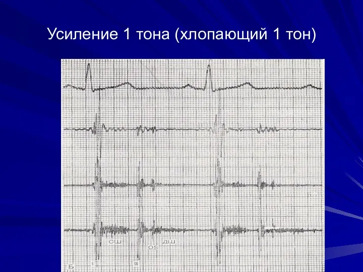 Усиление 1 тона (хлопающий 1 тон)