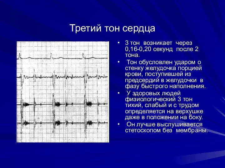 Третий тон сердца 3 тон возникает через 0,16-0,20 секунд после