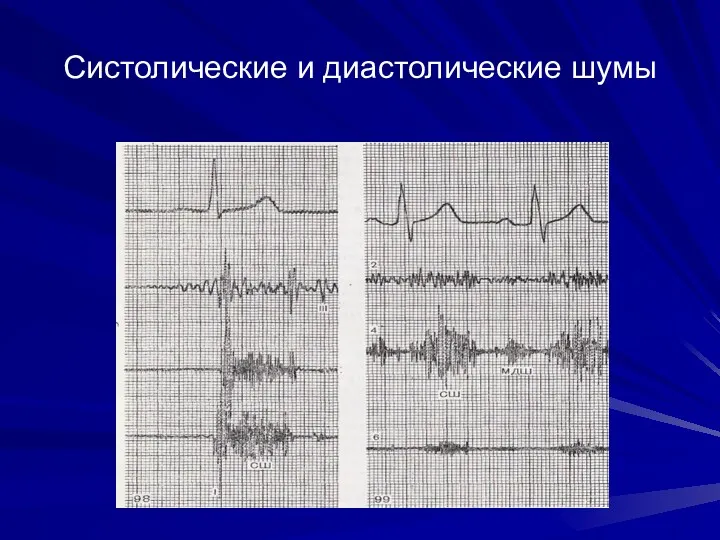 Систолические и диастолические шумы