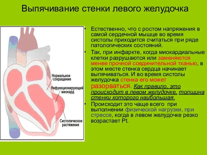 Выпячивание стенки левого желудочка Естественно, что с ростом напряжения в самой сердечной мышце