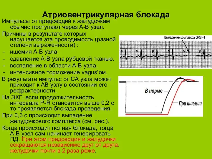 Атриовентрикулярная блокада Импульсы от предсердий к желудочкам обычно поступают через А-В узел. Причины