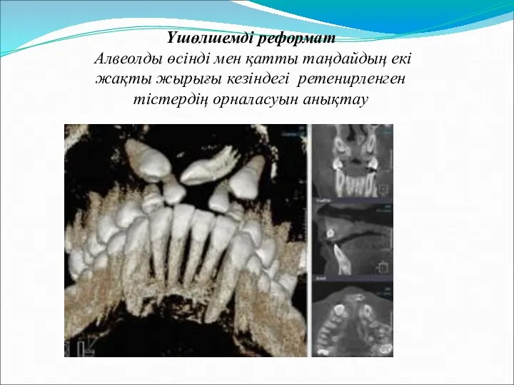 Үшөлшемді реформат Алвеолды өсінді мен қатты таңдайдың екі жақты жырығы кезіндегі ретенирленген тістердің орналасуын анықтау