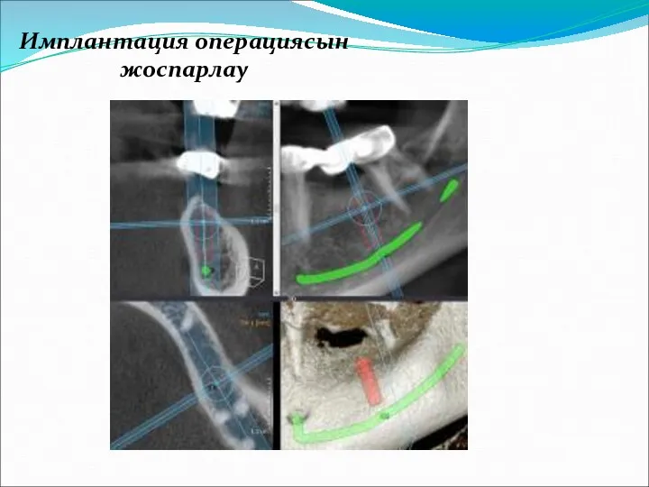 Имплантация операциясын жоспарлау