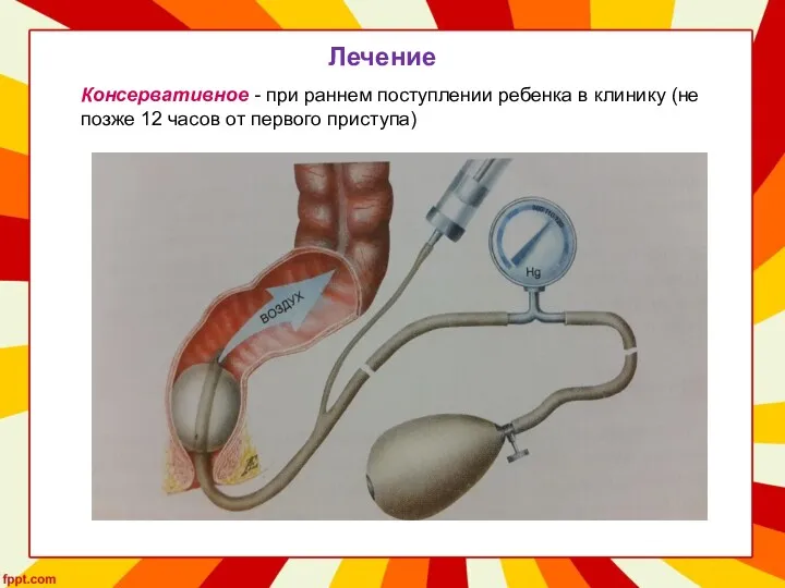 Лечение Консервативное - при раннем поступлении ребенка в клинику (не позже 12 часов от первого приступа)