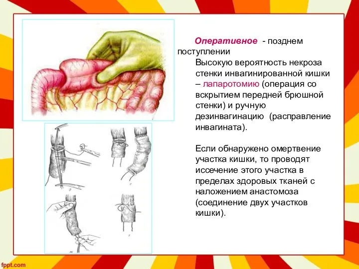 Оперативное - позднем поступлении Высокую вероятность некроза стенки инвагинированной кишки