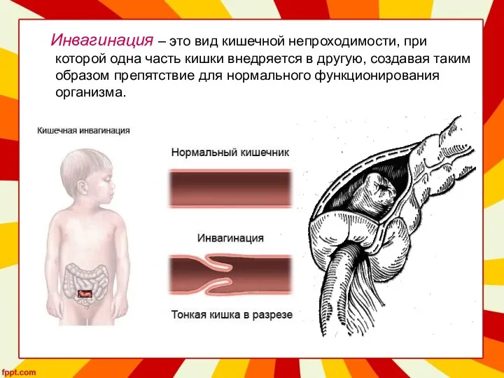 Инвагинация – это вид кишечной непроходимости, при которой одна часть