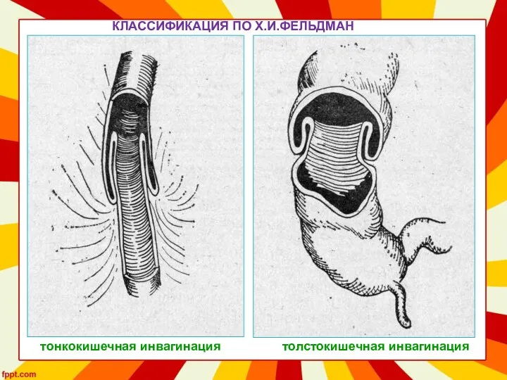 КЛАССИФИКАЦИЯ ПО Х.И.ФЕЛЬДМАН тонкокишечная инвагинация толстокишечная инвагинация