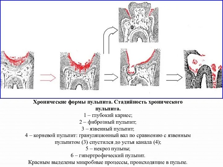 Хронические формы пульпита. Стадийность хронического пульпита. 1 – глубокий кариес;