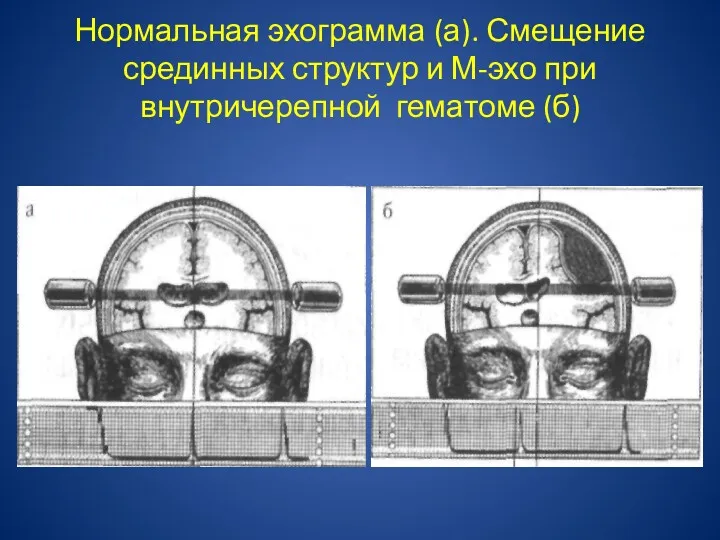 Нормальная эхограмма (а). Смещение срединных структур и М-эхо при внутричерепной гематоме (б)