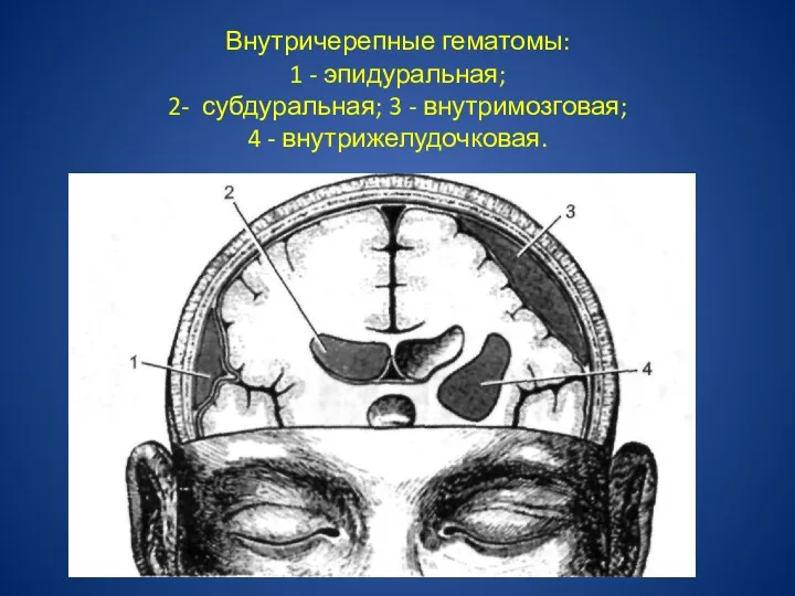 Внутричерепные гематомы: 1 - эпидуральная; 2- субдуральная; 3 - внутримозговая; 4 - внутрижелудочковая.